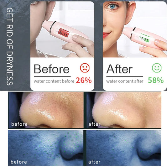 Water Oxygen Jet Machine Cold Hammer Suction Blackhead Facial Moisturizing Spray Injection SPA Micro Bubble Cleansing Instrument