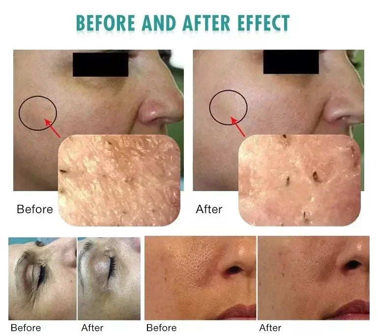 3 in 1 Hydrofacial Beauty Machine Oxygen Skin Rejuvenation Facial Tightening Machine For Skin Whitening CO2 Bubble+RF+Ultrasound - Merit Sell